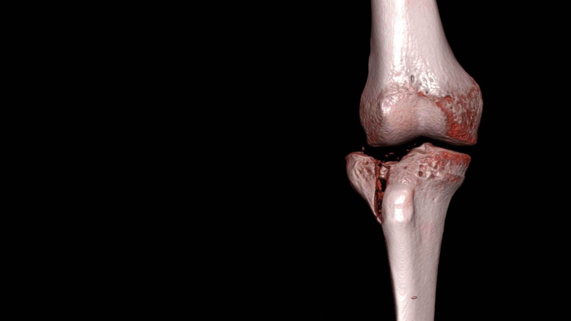 Knee Fractures