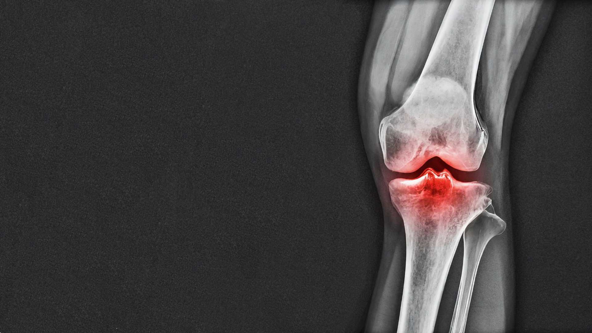 Cape Joint Surgery Sport Injury